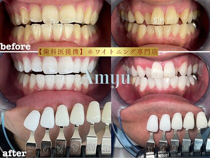 アミュホワイトニングの写真