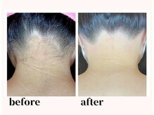 フルーブラン(Frubran)/都度払いで始める女性全身脱