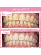 エクシアホワイトフジ(ecxia white fuji)/ホワイトニングビフォーアフター