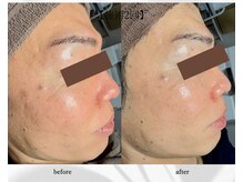 アン ビューティー(ann beauty)/施術2回【症例写真】30代