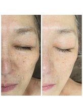 ヴィアス(VIAS)/プラズマフェイシャル　3回目