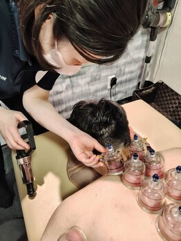 オードヴィー整骨院/【デトックス】カッピング