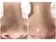 ミラボ(melab)の写真/【毛穴人気No.1】毛穴エクストラクション
￥13,500→￥8,800結果出しエステ★エステ初心者の方にも♪