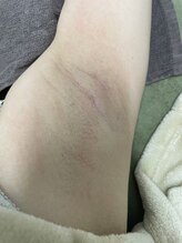 ナノハナ/鹿沼市の全身脱毛のナノハナ