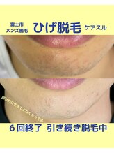 ケアスル 富士店/ひげ脱毛　メンズ脱毛