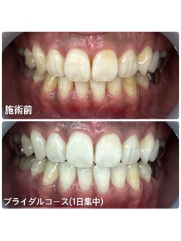 ホワイトニングサロン 京都烏丸店/ホワイトニング施術例