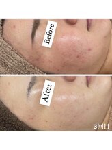 カルディエ(Cardie)/肌質改善　ビフォーアフター