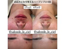 サロンドゥルシェル(salonde_le ciel)/お肌の土台を整えるハーブリプロ