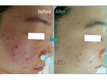 アリアンド(ari.and)/ララピール　症例写真