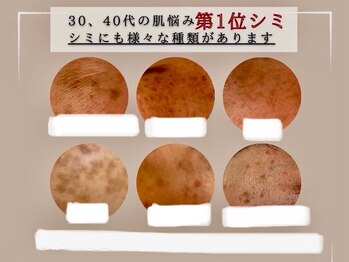 ベルエクラ(Bel Eclat)/シミには種類がある/那覇