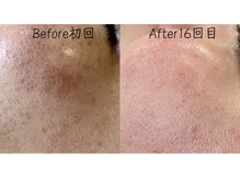 エリア(area.)/6、【シミケア13分】