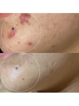 ソワ 吉塚店(soi)/あとになる前に!