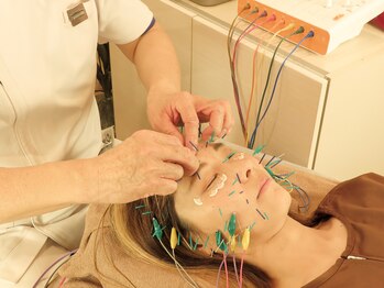 テンジンはり灸院(tenjinはり灸院)/目元は円皮鍼