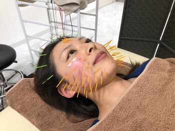 クローバー治療院の写真/ほうれい線・ゆるみ改善へ◎刺激の少ない美容鍼＆小顔矯正で悩みにアプローチ！