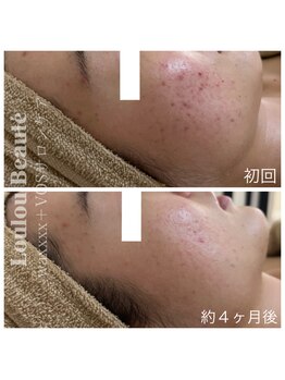 ルルボーテ(Loulou Beaute)/waxxxx+VOSサロンケア