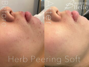 ベル 藤沢(Belle)/ハーブピーリング｜ニキビケア