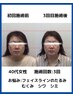 小顔しわシミ改善美容鍼 初回60分¥6500→￥3500