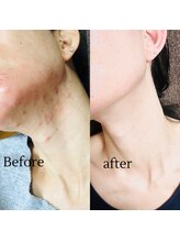 ヨサパーク リコア(YOSA PARK Likoa)/beforeAfter