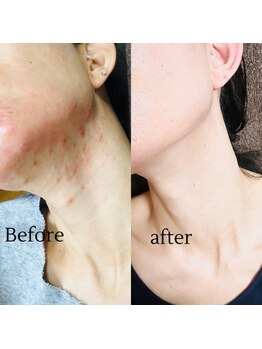 ヨサパーク リコア(YOSA PARK Likoa)/beforeAfter