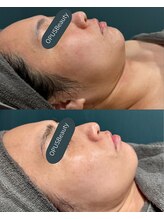 オーパス ビューティー(OPUS Beauty)/シミケア/しわ/たるみ/ニキビ