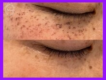 ハーブピーリング 名古屋/光ピール　プレミアム強め