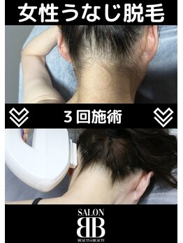 ビービー(BB)/レディースうなじ脱毛