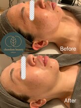 チョンダムビューティー(chondam beauty)/ハーブピーリングには自信あり！