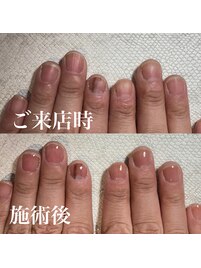自爪育成/深爪育成/ネイルケア