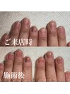 自爪育成/深爪育成/ネイルケア