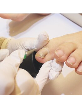 巻き爪補正店 横浜駅前店/1.プレパレーション（下準備）