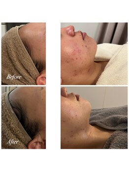 プララン 京都桂店(Plaran)/ダウンタイム有りピーリング