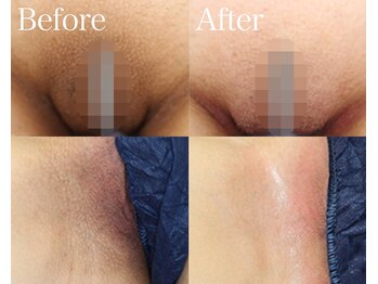 ライム 五反田(LIME)/ローマピンク|黒ずみケア