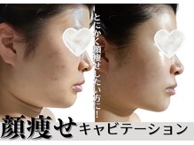 メイプル(Maple)/小顔希望はこのメニュー☆