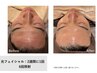 【赤ら顔改善//リフトアップ/毛穴ケア/シワ】うるおい肌◎光フェイシャル