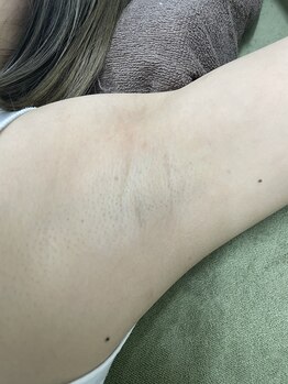 ナノハナ/鹿沼市の全身脱毛のナノハナ