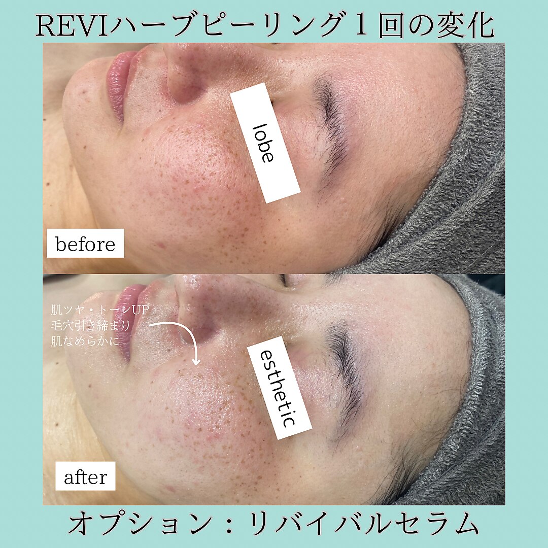 REVI ハーブピーリング 1回分 うごける REVI ハーブピーリング 1回分 うごける