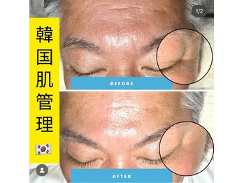 ディエール(Diailes)/目尻のお悩みにラミピール