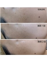 ハクア(HAQUA)/シミケア/フェイシャル/三ノ宮