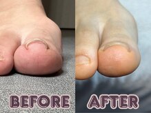 ポドロ ウィズ ニコルル 大阪天満店(PoDoLo with Nicolulu)/【巻き爪ケア】フットケア梅田