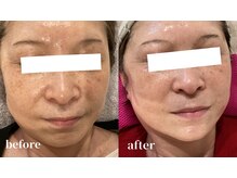 レアビューティー(Le'a beauty)/最強肌管理メニュー#艶肌リフト