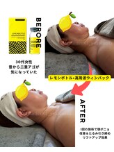 エステティックス ナインワンワン 横浜(Esthetics911) /レモンボトルで小顔リフトアップ
