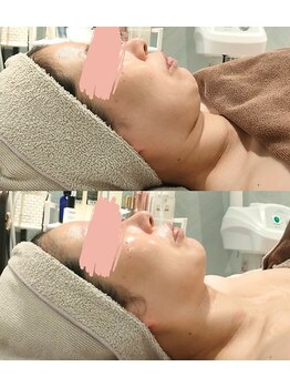 ソウナ(SONA)/ララピールの進化版ダクトピール