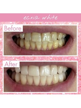 エクシアホワイトフジ(ecxia white fuji)/ホワイトニングビフォーアフター