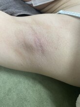 ナノハナ/鹿沼市の全身脱毛のナノハナ