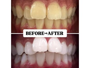 ホワイトニングサロン 豊中/【当店人気NO.1】10回コース♪