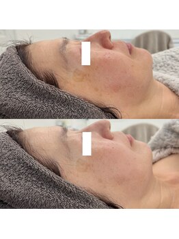 ヴェルシック(Belchic)/長年悩んでいたシミにアプローチ