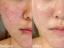 ホワイトアクア 北千住店(WHITE AQUA)/ハーブピーリング3回/ニキビケア