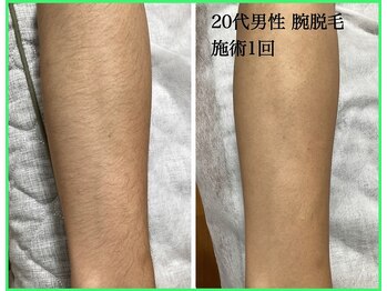 クリア 尾張旭店(Clear)/【Clear脱毛ビフォーアフター】