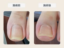 ルポ 伊勢の雰囲気(透明で目立ちにくい補正器具となっております。)