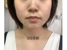 エステティック レイビス 池袋店(RAYVIS)/ハーブピーリング3日後朝